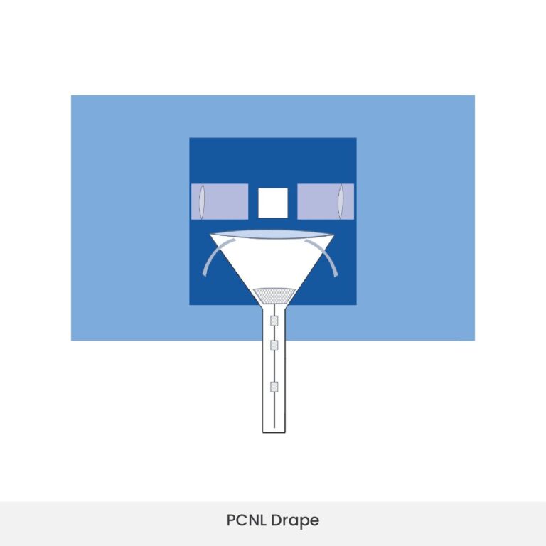 Kidney stone surgery drape with collection pouch in use